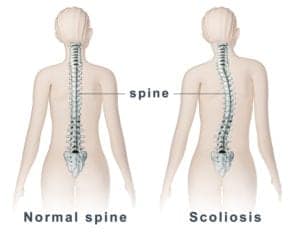 Scoliosis Care In New Zealand
