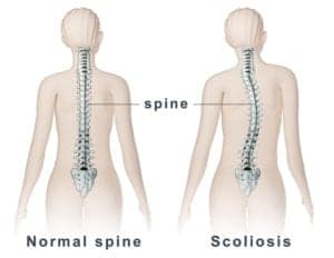 Scoliosis Care In New Zealand